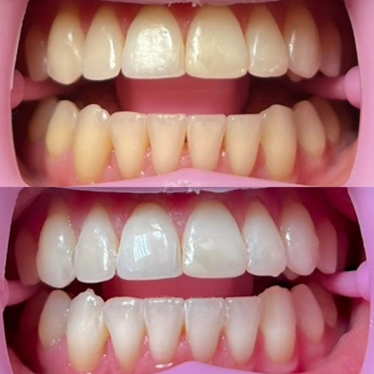 Purple Whitening Strips