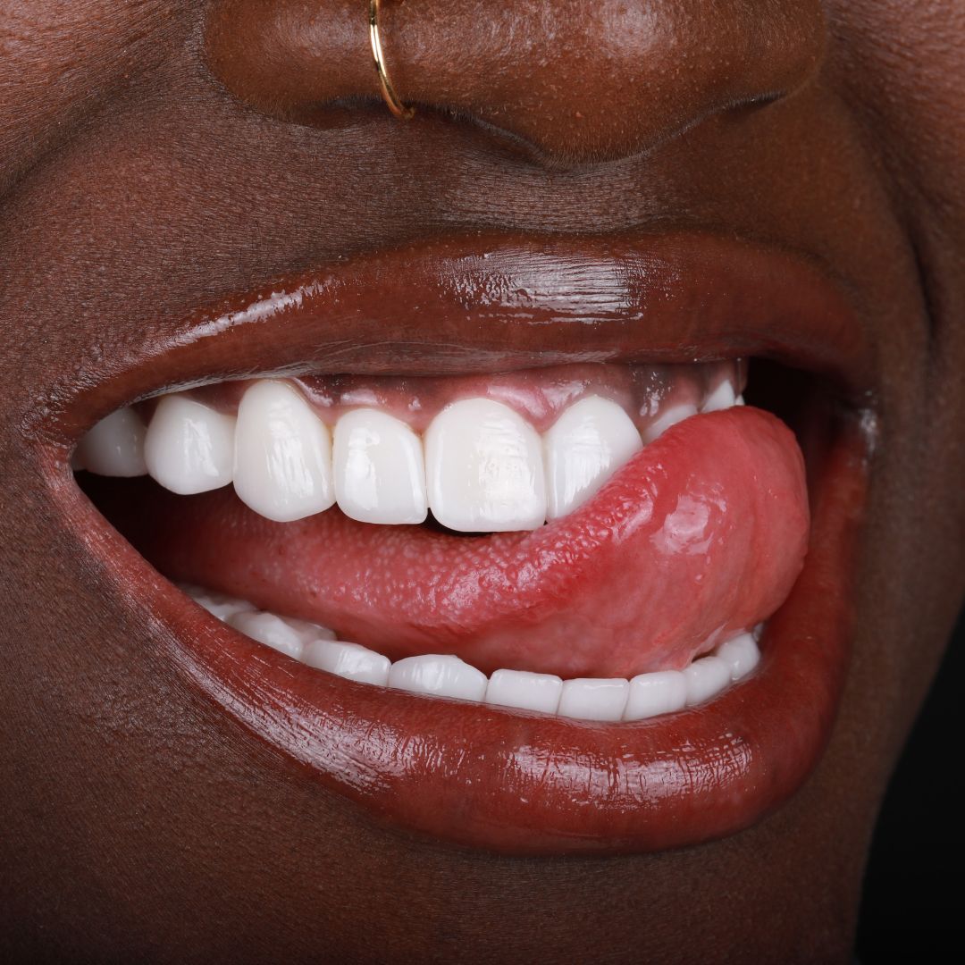 Purple Whitening Strips