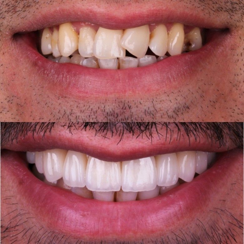 Purple Whitening Strips