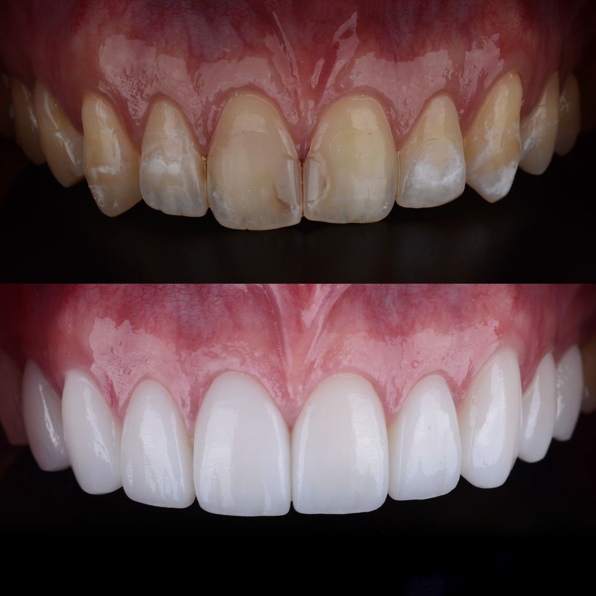 Purple Whitening Strips