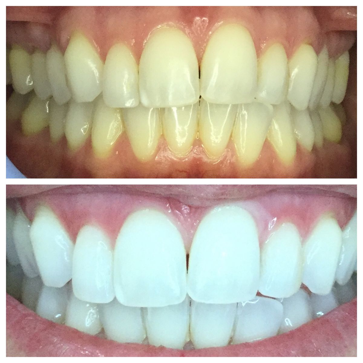 Purple Whitening Strips